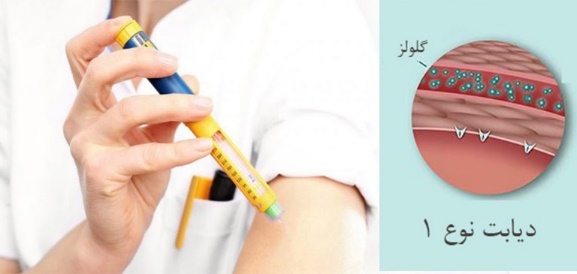 دیابت وابسته به انسولین
